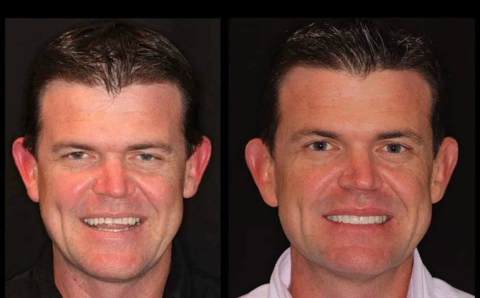 Cosmetic Dentistry Before and After Photo Coeur d'Alene